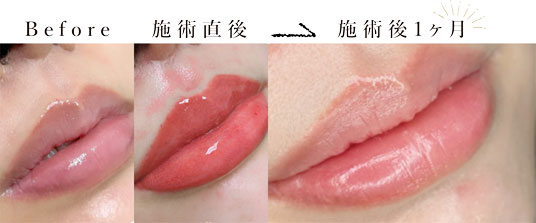 リップ・唇アートメイク症例写真