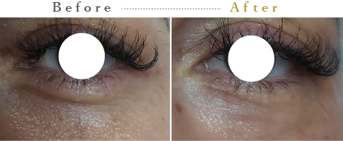 プルリアルシルク症例01