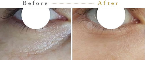 プルリアルシルク症例02