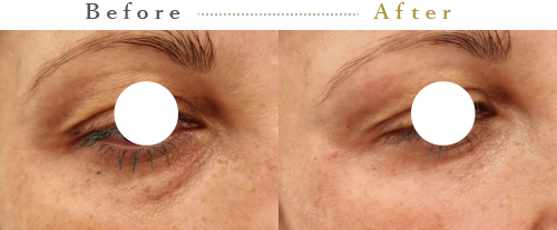 プルリアルシルク症例03