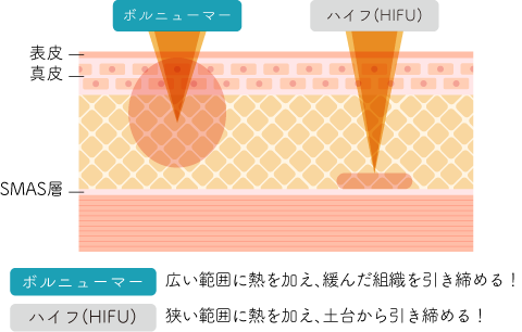ボルニューマとハイフの違い