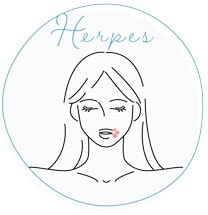 単純ヘルペス